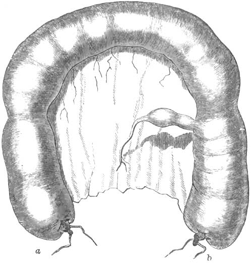 Natural relations of the
		diverticulum to the intestine