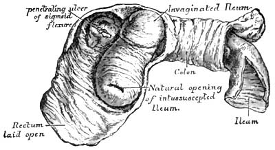 Intussusception